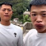生吃蜜蜂肿成香肠嘴的网红被封号
